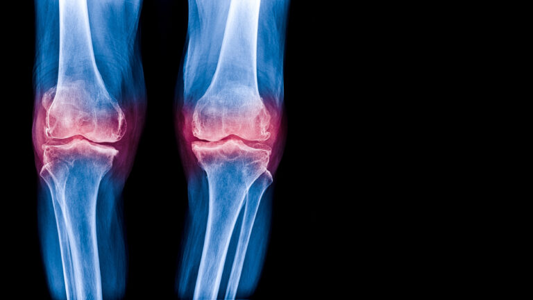 stem cell therapy for knee problems