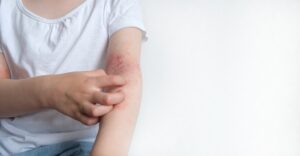 stem cell therapy for lupus