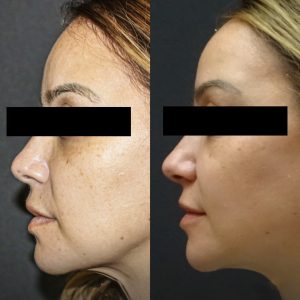 celulas madre facial antes y despus