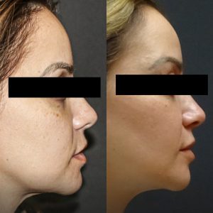 stem cell injection for face