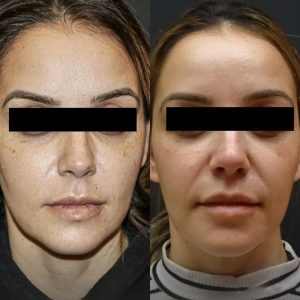 celulas madre en la cara antes y despues