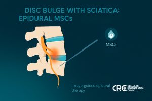 Medical infographic of lumbar spine with needle delivering an epidural injection near the nerve root for disc-bulge sciatica at CRC