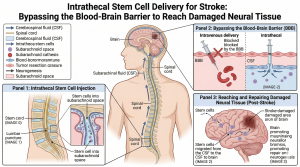 Medical illustration demonstrating intrathecal stem cell delivery via lumbar puncture, bypassing the blood-brain barrier to reach and repair stroke-damaged neural tissue in the brain.